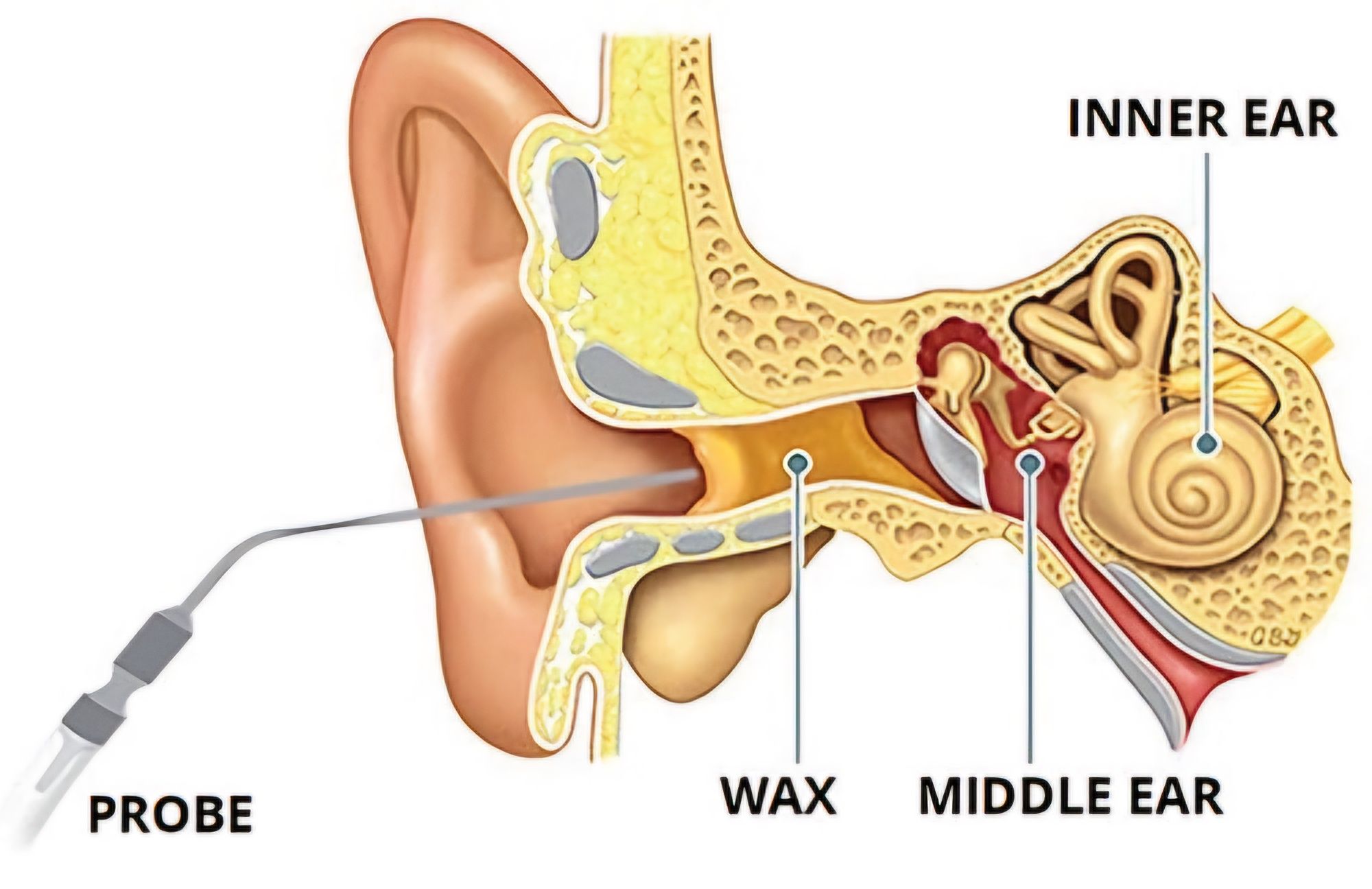 Earwax removal by Microsuction