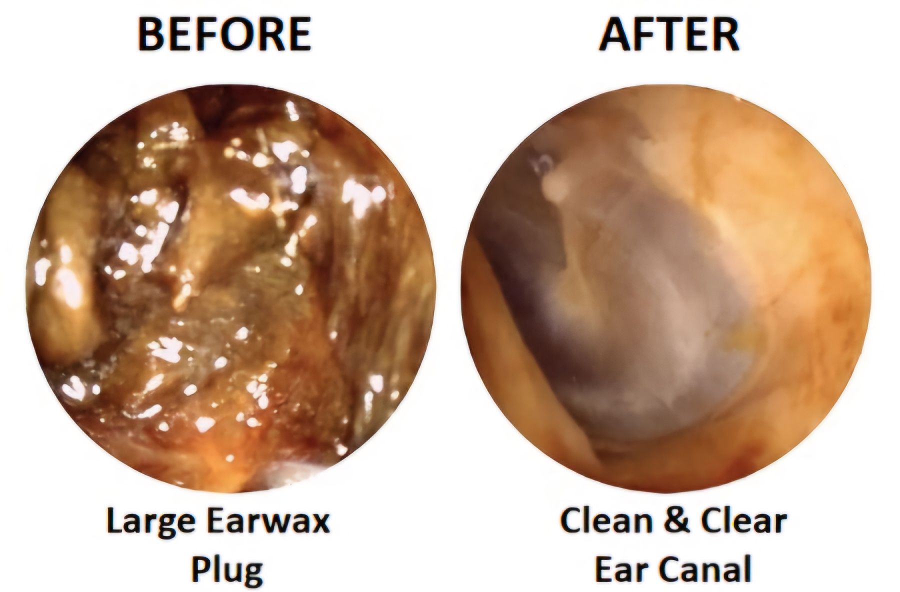 Earwax removal by Microsuction - Before and After